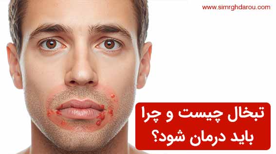 تبخال چیست و چرا باید درمان شود؟