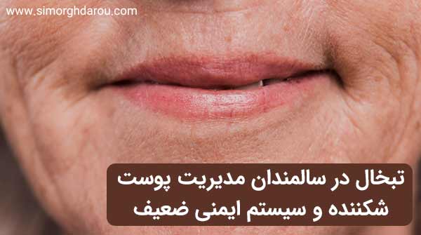 درمان تبخال لب در سالمندان