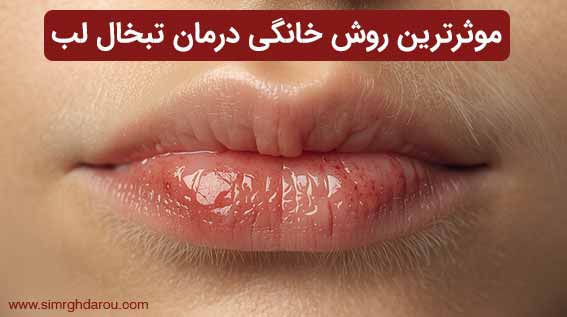 موثرترین روش خانگی درمان تبخال لب