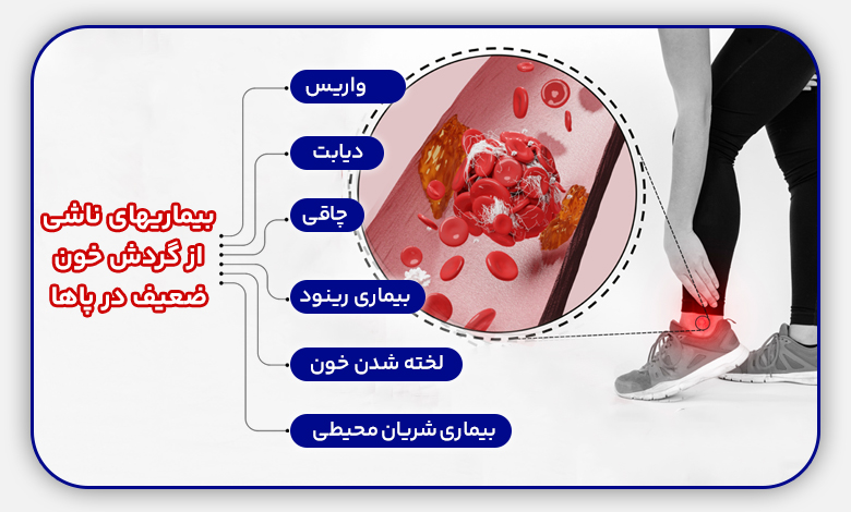 گردش خون ضعیف در پا باعث چه بیماری هایی میشود؟
